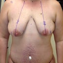 Day of surgery, right before going in.