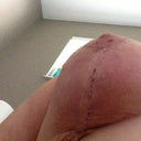 About a week & a half post op