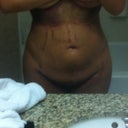 Post Op Day 2