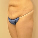 Before, with skin apron.  You would never know to look at this photo I killed myself in the gym every morning, every day for an hour, because you simply cannot see any muscle definition with the excess skin...
