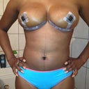 Post-op day 4. Still boob and tummy swelling, but definitely getting better.