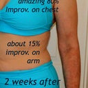 unfortunately I don't have any 'before 1st treatment pics' - sorry. Here's one taken about 2 weeks AFTER the 1st treatment