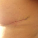 Side scar almost invisible