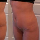 Week 6. Tightening right up since resuming calisthenics. Round lower belly. Is it still swollen?