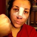 Funny picture I sent my friends. Day of surgery. Told them I got into a fight! :)