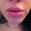 4 weeks post treatment...look bigger in the picture because it's a close up.