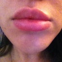 4 weeks post treatment...look bigger in the picture because it's a close up.