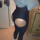 Day one few hrs after surgery