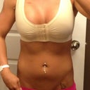 One day post op
