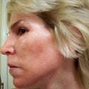 1 Day After Chemical Peel
