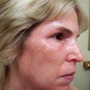 1 Day After Chemical Peel