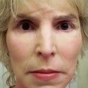 5 Days After - All skin peeled, this is with make-up