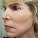 5 Days After- All skin is peeled, this is with make-up