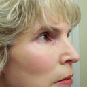 5 Days after - All skin is peeled, this is with make-up