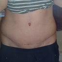 Still swollen on the sides.
