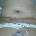4 days post opp