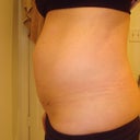 After developing a bad itchy throat and cough (3rd week after surgery), and after taking Dr. prescibed meds I couldnt kick the cough and I felt a pull on the stitches.  At week 8 after pushing a unfilled shopping cart in Target I felt a "pop" and then a "uneven" feeling...I went home and took these pictures.  At 8 weeks.