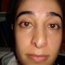 6 months post-op front view
