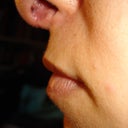 6 months post-op side profile