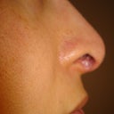 6 months post-op side profile