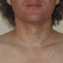 Possibly the least-favorite photo of me you'll ever see on here ... my Adam's Apple before surgery.