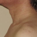 Possibly the least-favorite photo of me you'll ever see on here ... my Adam's Apple before surgery.