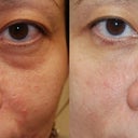 nasolabial and under the eyes