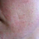 After first time doing current regime. Not the deep line that was a dimple before no runs in a horseshoe right around my chin and up the other side