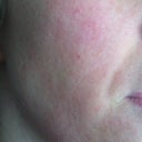 After several treatments