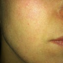 After 3 weeks. Note the lift and firmness as well as more even texture