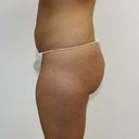 Before surgery