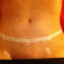 1 week po from incision revision.. So Happy!!