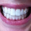 With aligners in, buttons on top and bottom