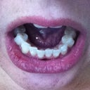 Without aligners in, bottom teeth progress tray 7 (about 3 months)