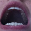 Without aligners, top teeth progress tray 7 (about 3 months)
