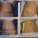 This is before my lipo...and after. Smoothed it out dramatically!!!