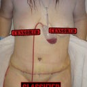 PO2 surgery was done on 2/26/13. My first shower and photo after surgery