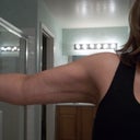 22 years later after loosing 125 pounds, I never did lose the fat on my forearms, but now I feel more proportionate.