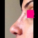Side after