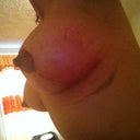 4 weeks post op