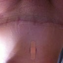 Close up of scar, sorry it is upside down =0(