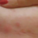 Day 16 post op. Scar letf side.