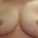 Day 16 post op.