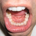 Aligners - 5/16
- You can see the crowding of the lower teeth pretty well here. After 5 trays, it is MUCH easier to floss between my lower teeth.