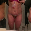 Day 3 Post Op. I am VERY pleasantly surprised! My belly button isn't distorted at all!