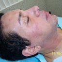 SIDE VIEW DURING LASER