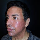 THE NEXT DAY SIDE VIEW (Bronzing of the skin)