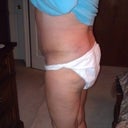 5 weeks PO Side view, still bruised from lipo