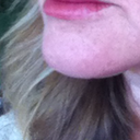Day 10 - much improved but still swelling above top lip.
