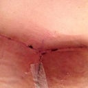 Under my left breast. 11 days post op.